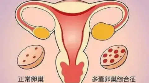 中医和西医哪种治疗对多囊卵巢效果好？