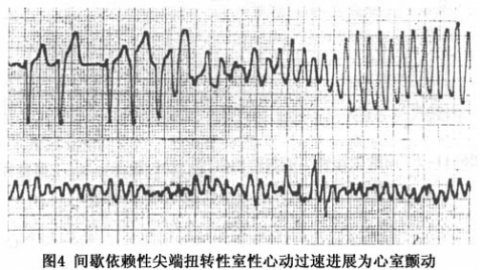 短QT间期综合征
