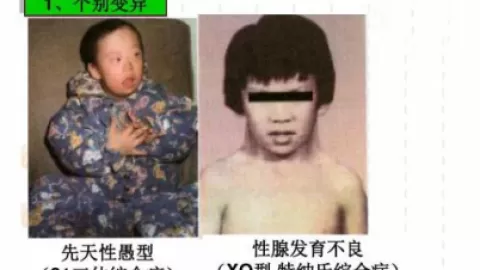 什么是特纳氏综合症