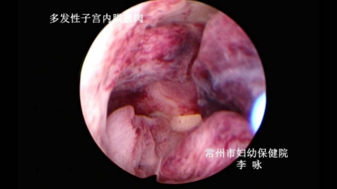 宫腔镜检查知多少