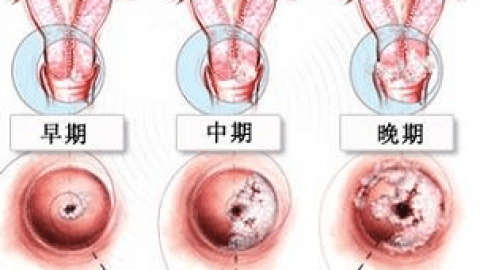 进行宫腔镜检查是查什么的更新时间:2018-03-23
