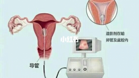 女性不孕一定要做输卵管造影检查吗？输卵管造影检查后可能会带来哪些并发症？