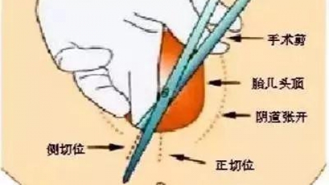 顺产侧切到底怎么切 一图读懂它（附过程图片）
