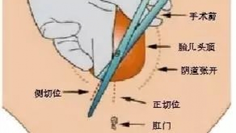 慎点：会阴侧切与撕裂真人图 ，女人太不容易啦！