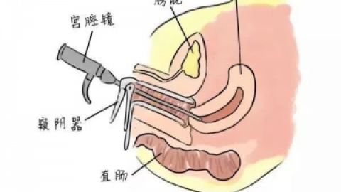 关于宫腔镜检查，你要知道的4大真相