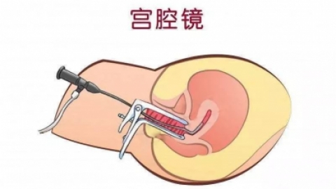 宫腔镜——子宫环境的“照妖镜”