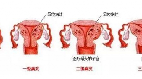 子宫腺肌症的症状