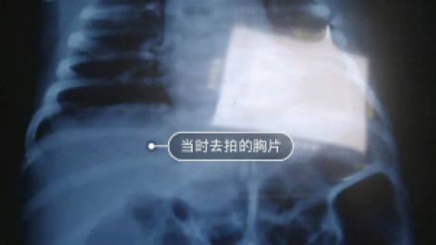 辟谣丨亲身经历，新生儿咳嗽、呛奶、吐泡泡不一定是肺炎！