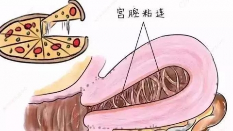 宫腔粘连 什么是宫腔粘连