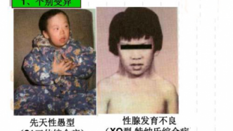 特纳氏综合征的诊断方法