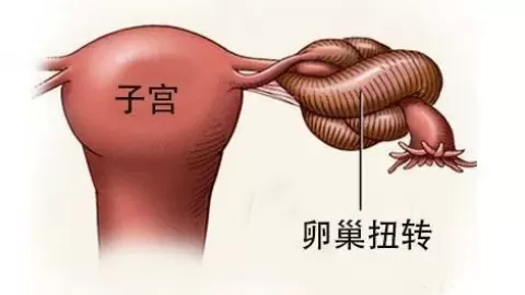 > 卵巢巧克力囊肿会扭转吗?