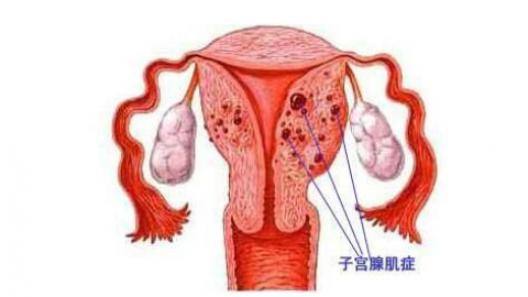 子宫腺肌病,子宫腺肌病如何治疗,子宫腺肌病症状