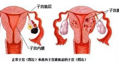 子宫腺肌病最新指南