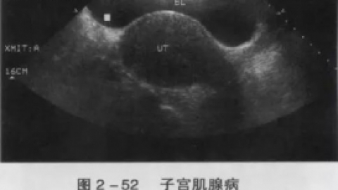子宫腺肌病到底是个什么病？图片真的血腥！