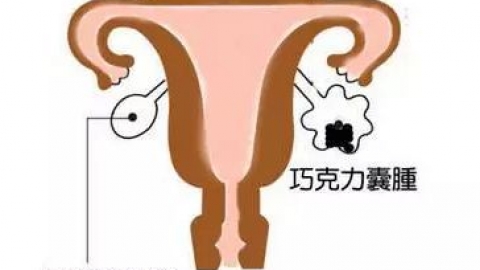 预防巧克力囊肿方法都有哪些
