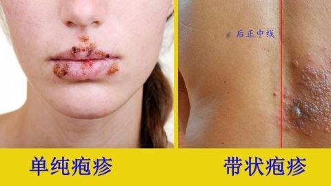 带状疱疹是癌前预警吗？