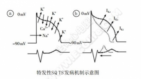 短QT综合征（短QT间期综合征、SQTS）(心血管 经典心电