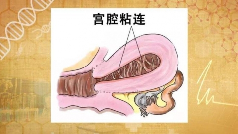 【宫腔粘连】宫腔粘连的症状、治疗方法以及姐妹们的真实经历分享！