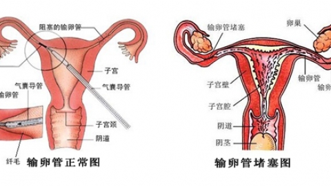 子宫输卵管造影PPT_基础医学_医药卫生_专业资料