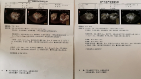 巧克力囊肿斗争史