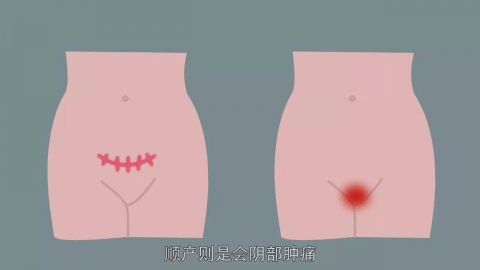 女人顺产生孩子会阴侧切全过程（图片）