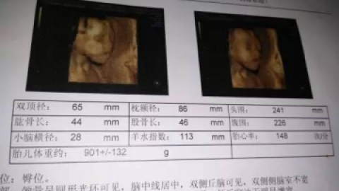 NT是什么？NT检查有必要查吗？