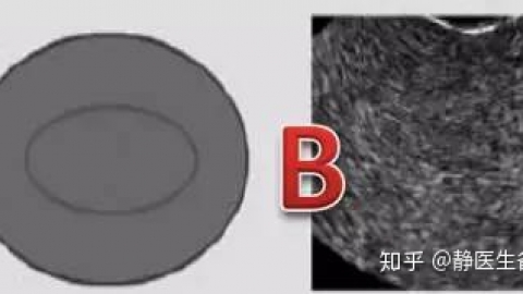 子宫内膜过薄会影响怀孕吗