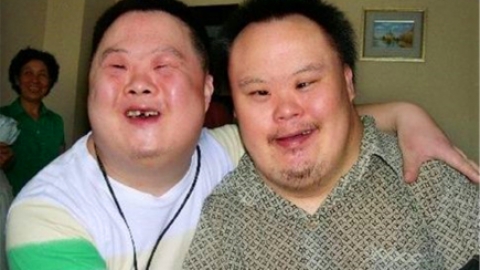 唐氏综合症是什么