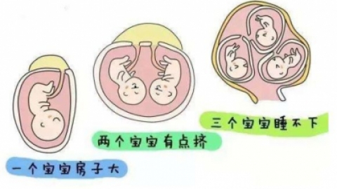 多胎妊娠的治疗要点是什么