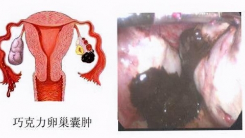 巧克力囊肿,巧克力囊肿如何治疗,巧克力囊肿症状
