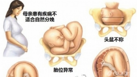 多胎妊娠怎么治疗