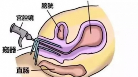 宫腔镜揭秘，女性宫腔的“放大镜”
