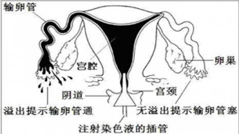揭秘输卵管造影——我们不一样