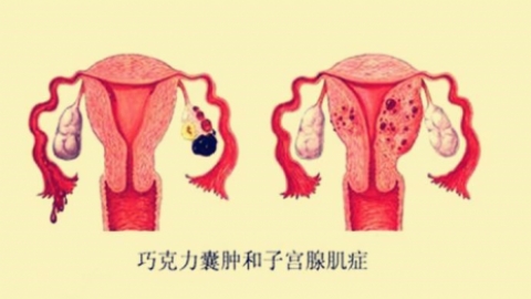 巧克力囊肿真的无法根治？