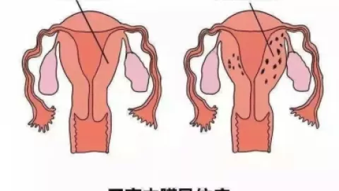 女性子宫腺肌症是一种什么体验？
