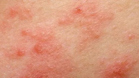 单纯疱疹病毒的分类介绍