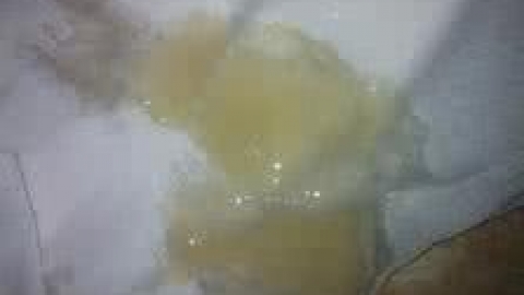 导致弱精症的原因有哪些？ 治疗弱精症的5种方法