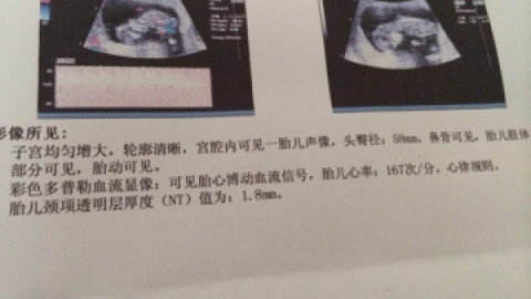你不了解的唐氏综合症