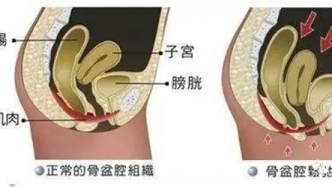 侧切 “侧切”影响性生活 加强锻炼是关键
