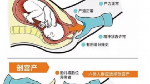 会阴侧切 8位妈妈亲身谈感受