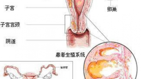 子宫腺肌症的治疗方法