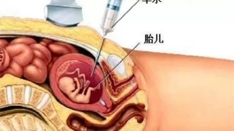 我国的唐氏综合症发病几率很高么？