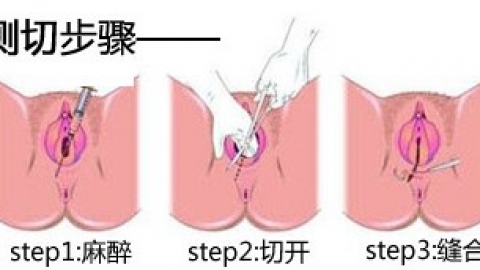 顶级专家：顺产如何做才能不用侧切？