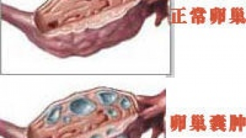 有卵巢囊肿还能怀孕吗?一定要手术处理吗？