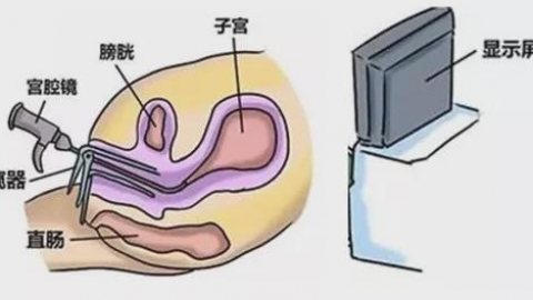 宫腔镜是什么？出现这5种情况，建议及时做宫腔镜检查！