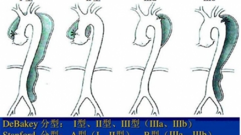 马凡氏综合症如何确诊？