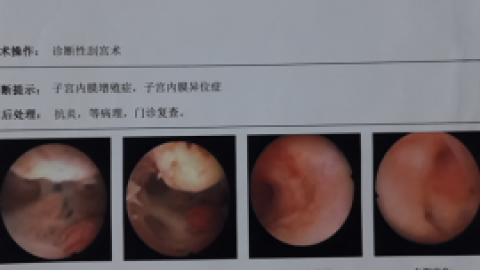 子宫输卵管造影检查须知