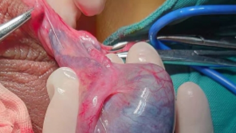 睾丸扭转的治疗,睾丸扭转应该如何治疗