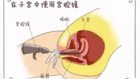 宫腔镜是什么检查