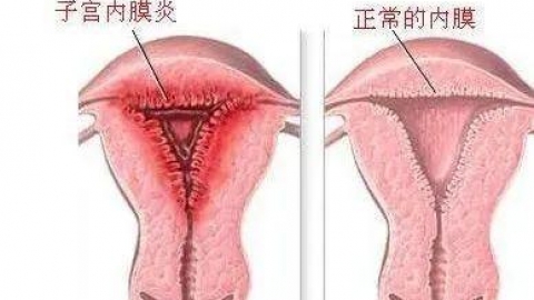 宫腔粘连症